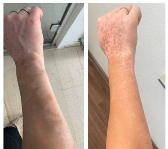 Vitiligo an der Hand vor und nach der UVB-Lichttherapie