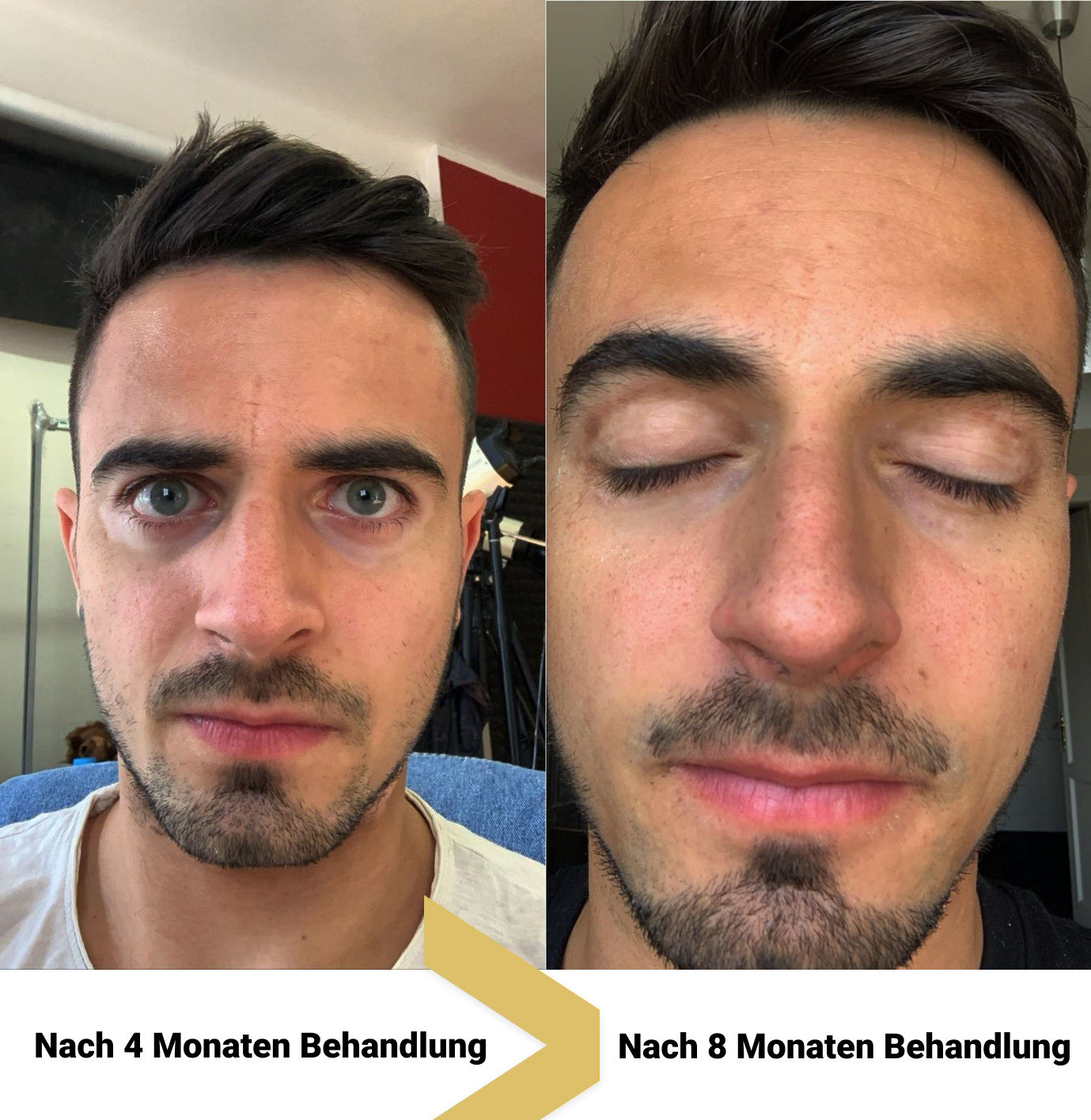 UVB-Lichttherapie zur Unterstützung der Repigmentierung