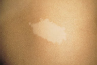 nevus depigmentos