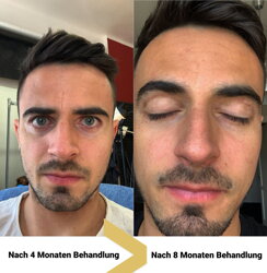 Vitiligo nach Körperstelle