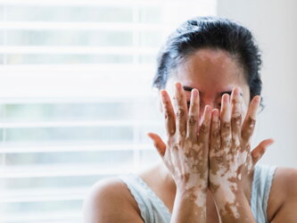 Faktoren, die die Behandlung von Vitiligo beeinflussen