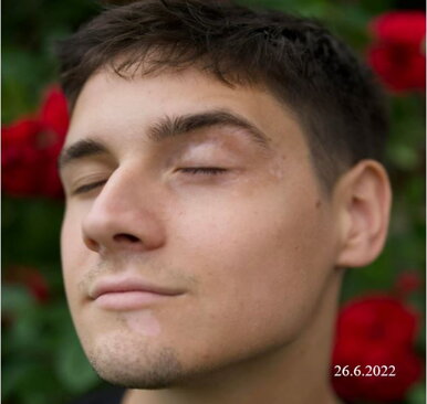Vitiligo man