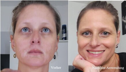 Vitiligo im Gesicht