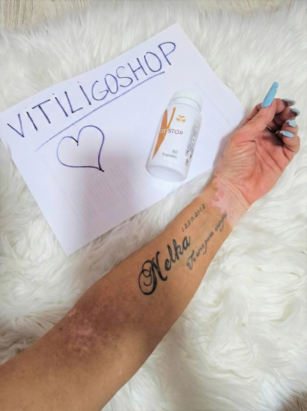 Lena Vitiligo Behandlung Vitistop Tabletten