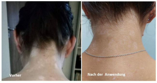 Vitiligo-Hals