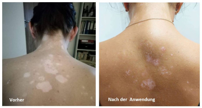 Vitiligo Frau