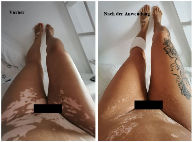 Vitiligo Frau