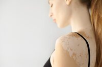 Vitiligo - Weißfleckenkrankheit