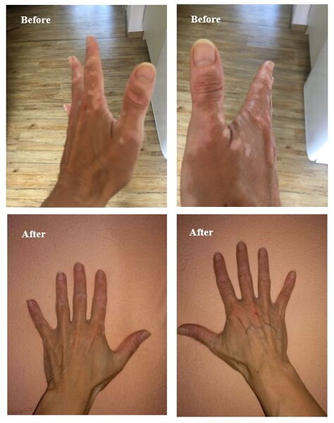 Aktive oder stabile Vitiligo? Woran Sie erkennen, dass sie sich ausbreitet – und was das für die Behandlung ändert