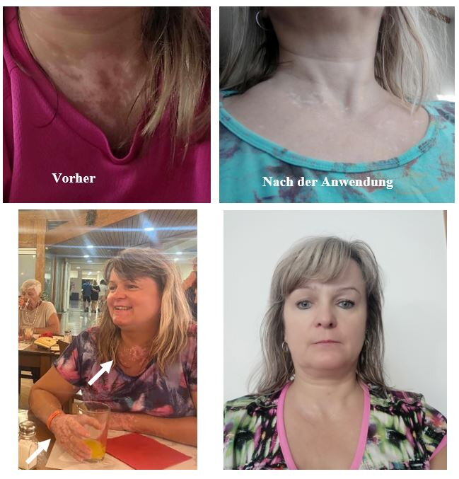 Vitiligo an Hals und Dekolleté – Janina V., Kundin von VitiligoShop