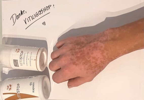 Vitiligo an Hand und Fingern – Julia, Kundin von VitiligoShop