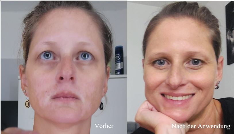 Vitiligo im Gesicht vorher und nachher – Petra B., Kundin von VitiligoShop
