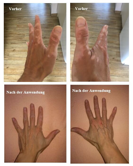 Vitiligo an den Händen vorher und nachher – Petra K., Kundin von VitiligoShop