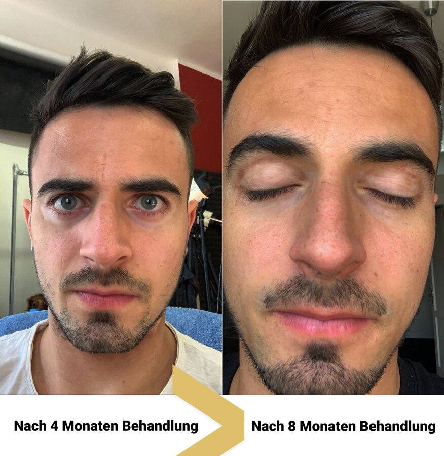 Vitiligo im Gesicht nach 4 und 8 Monaten – Peter, Kunde von VitiligoShop