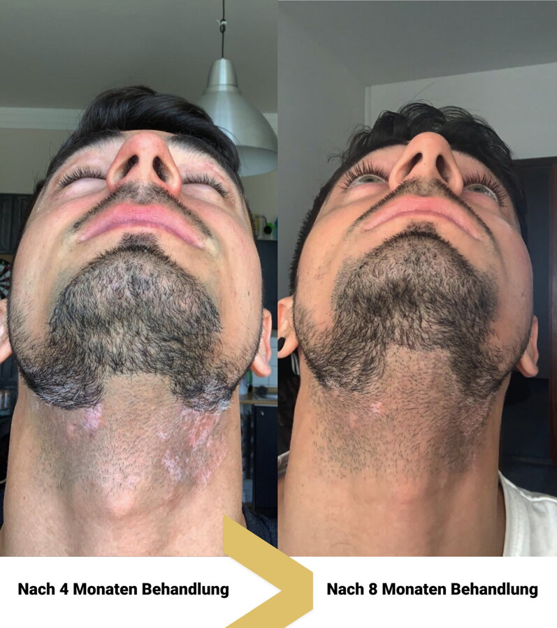 Vitiligo am Hals vorher und nachher – Peter, Kunde von VitiligoShop